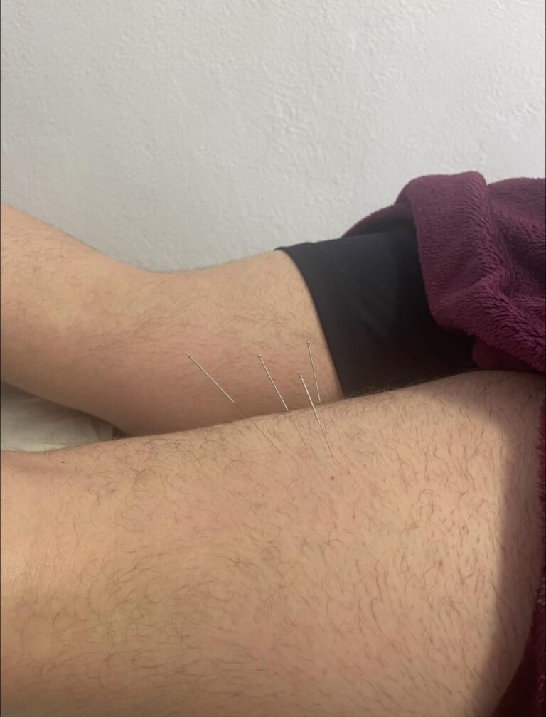 dry needling offaly banagher